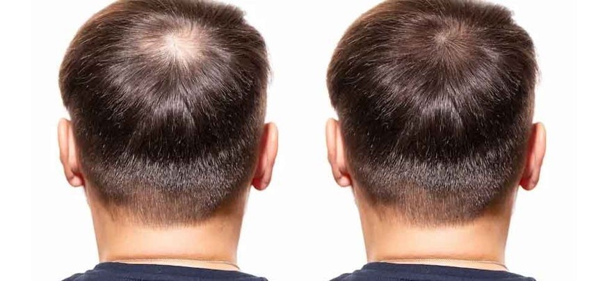 hair replacement treatment