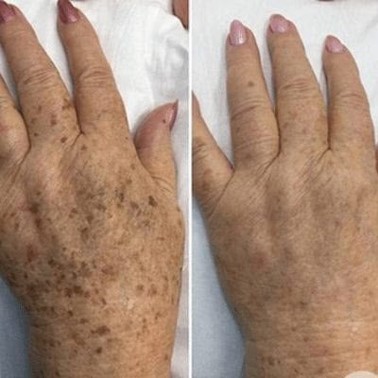 pigmentation reduction